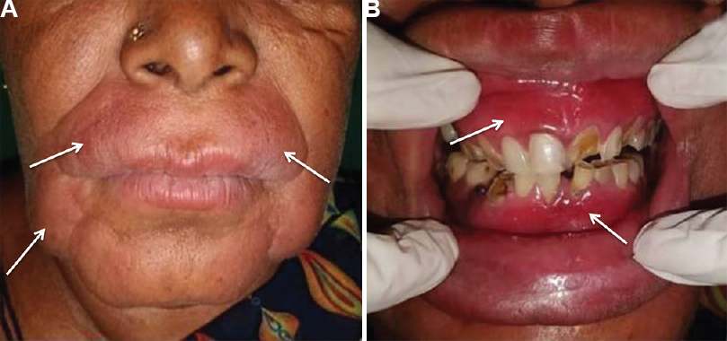 (A) Swelling on her lower and middle third of the face (arrows). (B) generalized oedematous and erythematous gingiva with respect to both upper and lower arch (arrows).